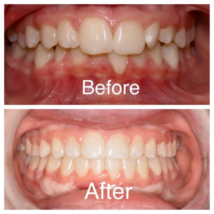 get teeth straightened without braces, dentist for teeth alignment