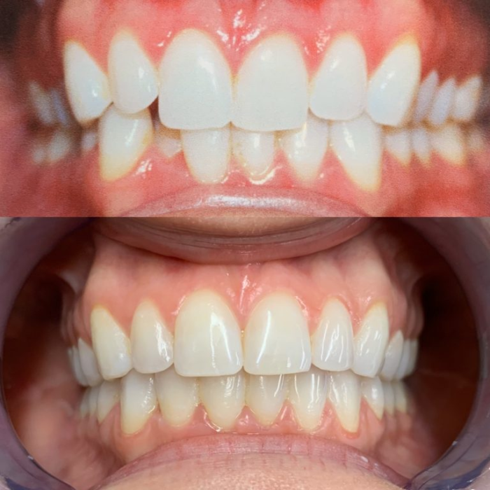fastest teeth straightening, fastest way to straighten teeth without braces, straight teeth like naturally