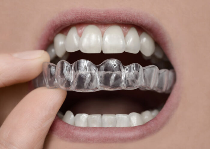 invisible aligners near me, keep teeth straight, perfect teeth without braces